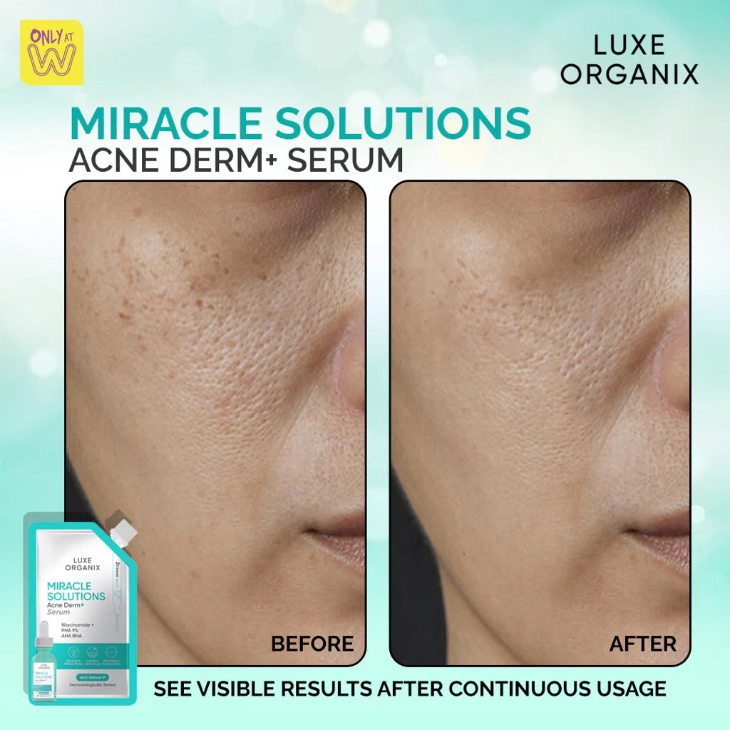Miracle Solutions Acne Derm+ Serum 7ml